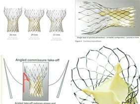 The first non-surgical aortic valve replacement via femoral artery performed in Shahid Modaress Hospital